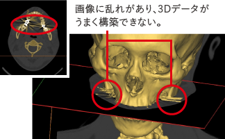 アーチファクトなどで発生した画像のノイズをmimicsで除去できます