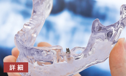 インプラントシミュレーター事例